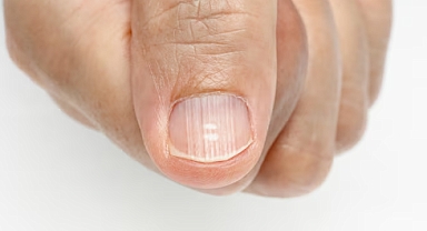 Tırnaklarda beyaz leke neden olur, nasıl geçer?