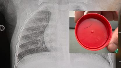 Bebeklerdeki Sırt Ağrısını Hafife Almayın! Sırtından Zımba Teli Çıkan Bebek Herkesi Korkuttu