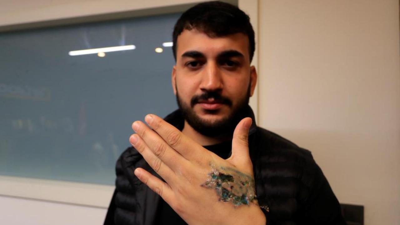 Dövme Sildirmek İstedi, Elinden Oluyordu: "Ağrı Kesici Al" Deyip Gönderdiler!